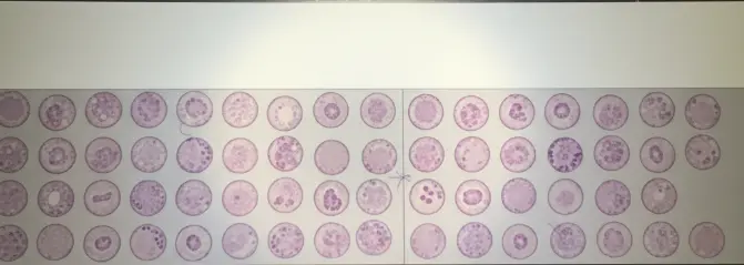 Breast cancer tissue array, including pathology grade, TNM and clinical stage, IHC marker (ER, PR, HER2 and Ki-67), 114 cases/114 cores, replacing BR1141, unbaked, fresh cust, unstained
